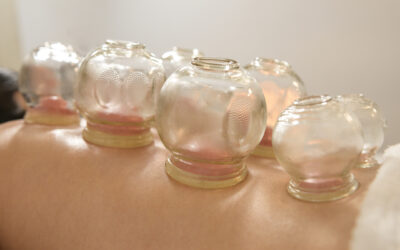 Phoenix, AZ – Discussing Cupping Methods Used at Top-Rated Chiropractic Clinics